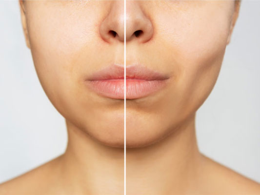 Who is a Suitable Candidate for Buccal Fat Removal?