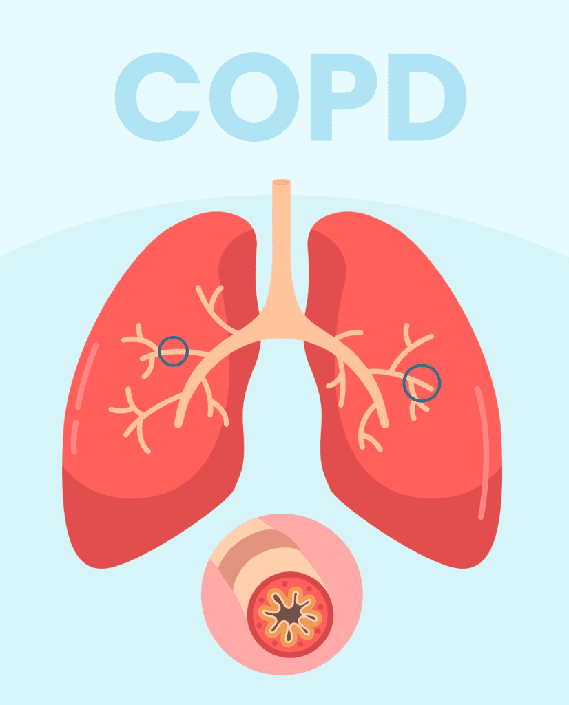 What are the symptoms of COPD? Doctor Near Me