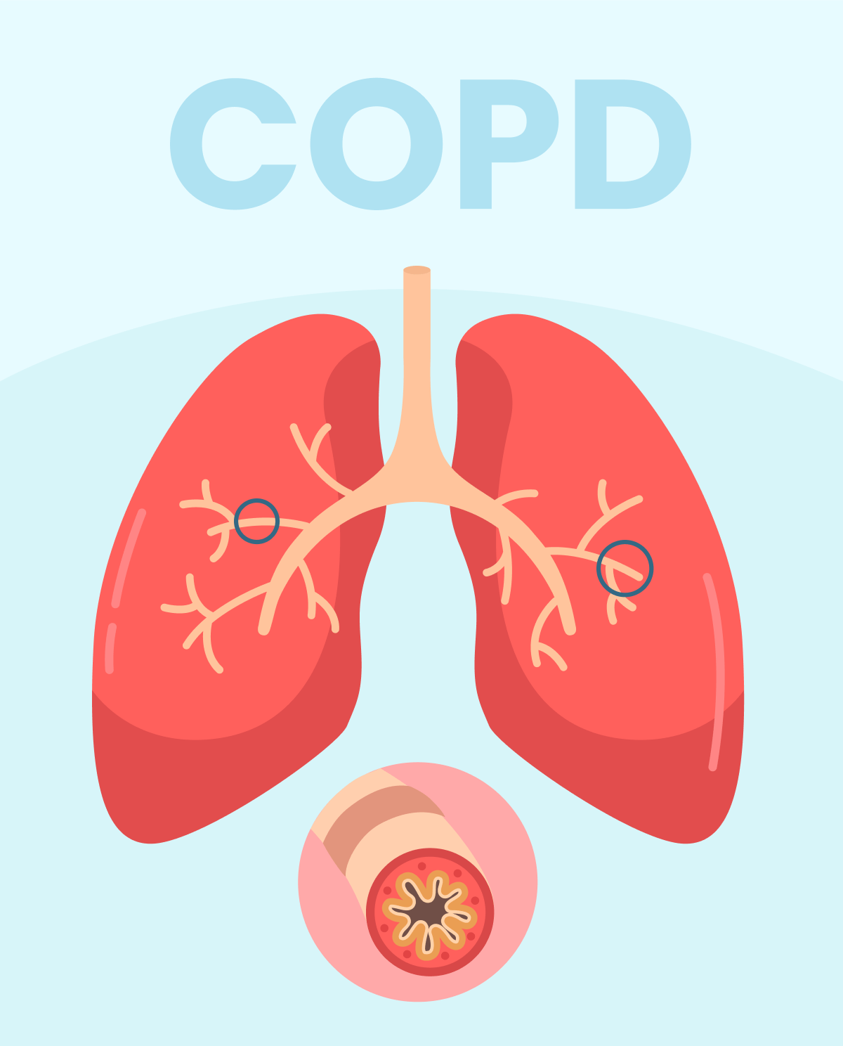 What are the symptoms of COPD?