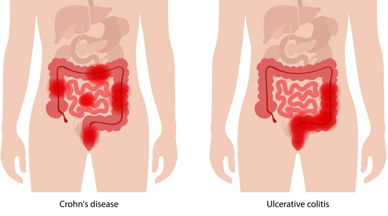 What are the key differences between Ulcerative Colitis and Crohn’s Disease?