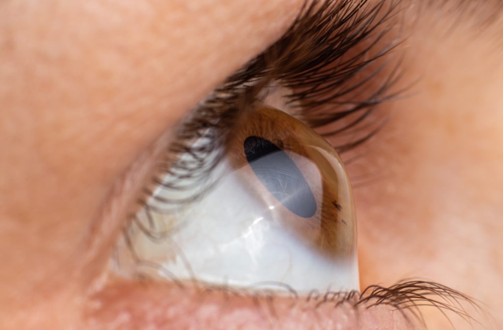 Can Keratoconus be cured?