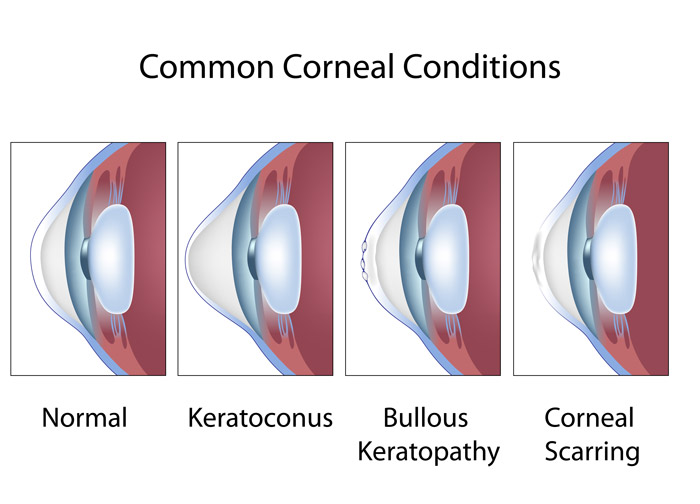 What are common conditions that affect the cornea?