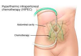 HIPEC Treatment in Mumbai | Dr. Chintamani Godbole