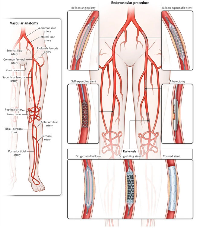 What are the comprehensive treatment options for Peripheral Arterial Disease?