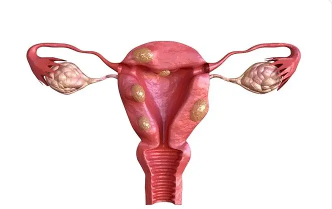 How are uterine fibroids diagnosed?