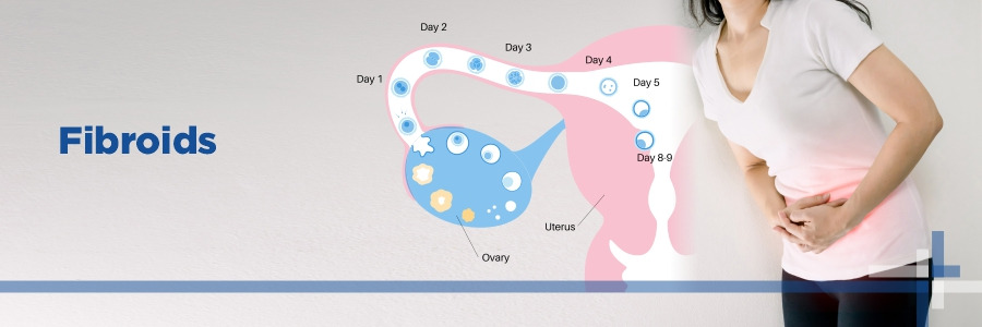 Which indicators are often seen in women with fibroids?