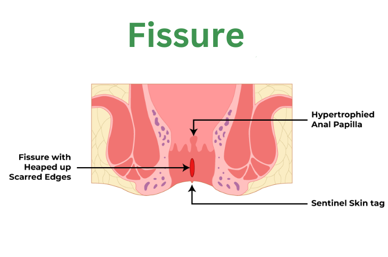 When is surgery recommended for anal fissures?