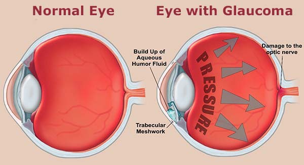 What are the common treatments for glaucoma?