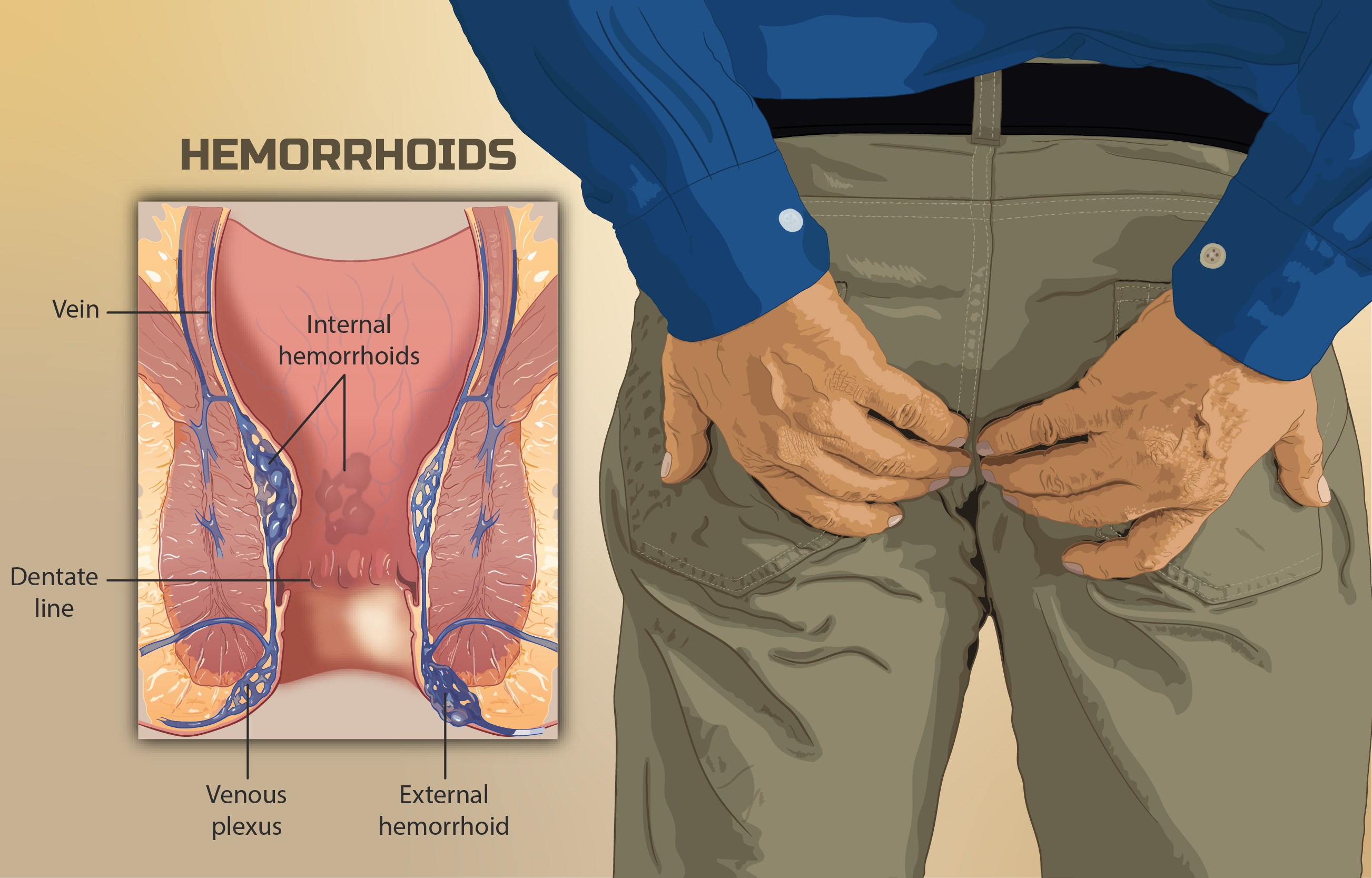 When should I see a doctor for hemorrhoids?