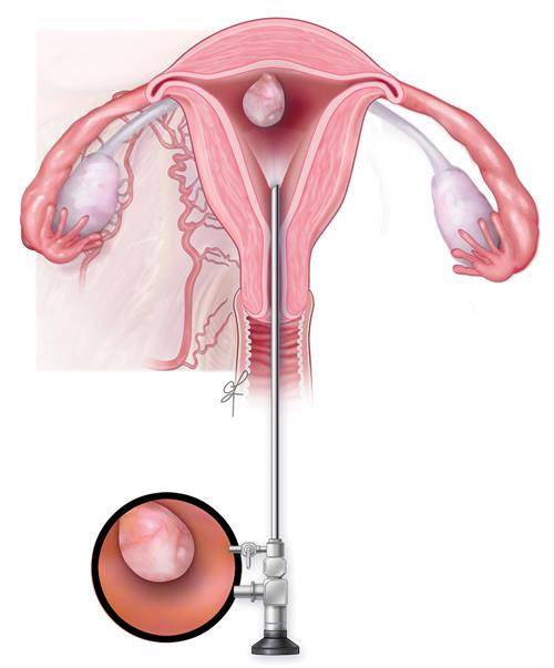 Is hysteroscopic myoma resection suitable for everyone?