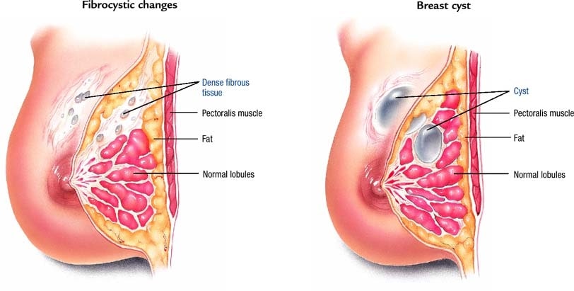 How are benign breast diseases diagnosed?