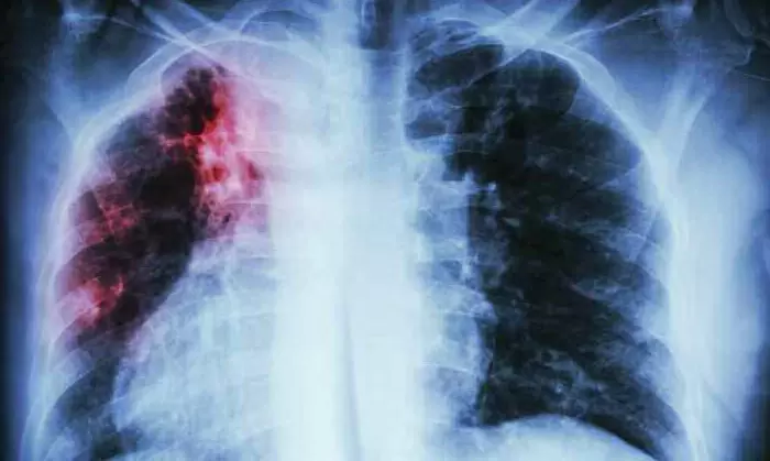 What Causes Interstitial Lung Disease?