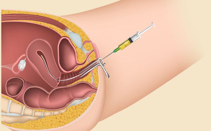 How many IUI cycles may be needed to achieve pregnancy?