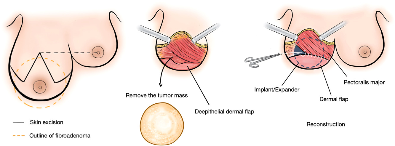 Can fibroadenoma removal affect breastfeeding?