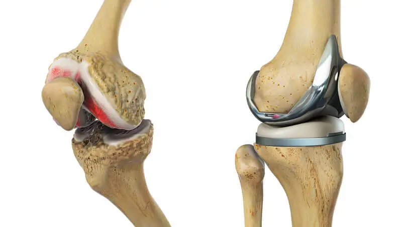 Why is knee replacement surgery performed?