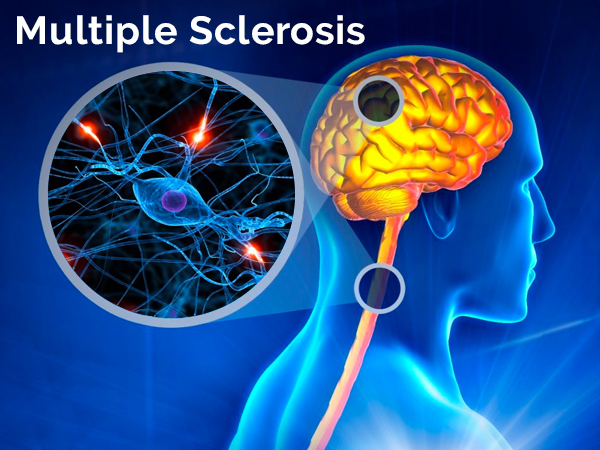 What are the common symptoms of Multiple Sclerosis ?