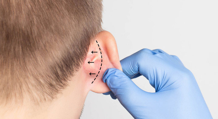 Who can benefit from otoplasty for ear appearance ?