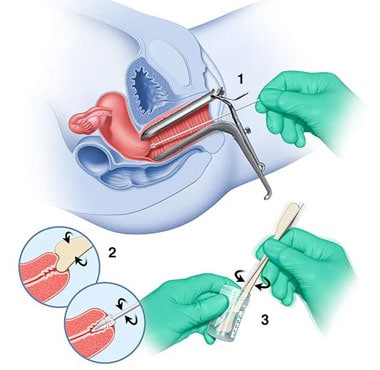 When Should I Have My First Pap Smear?