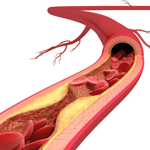 What causes Peripheral Vascular Disease (PVD)?