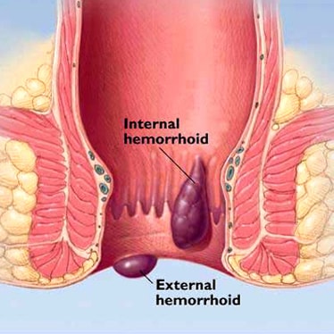 Colorectal Surgeon in Mumbai | Dr. Chintamani Godbole