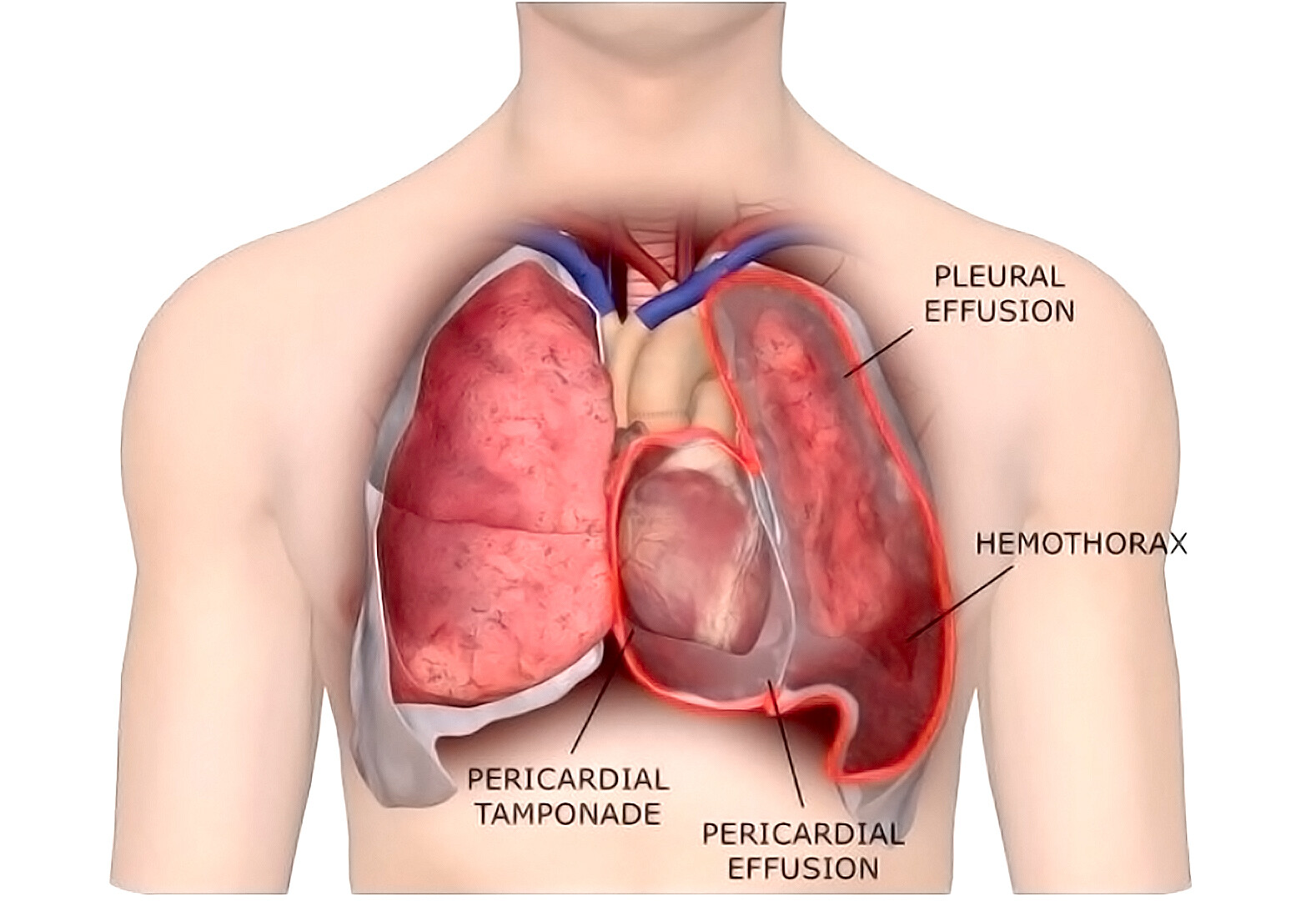 What are the symptoms of pleural diseases?