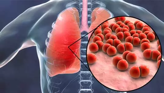 What are the Common Symptoms of Pneumonia?