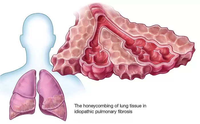 What are the symptoms of pulmonary fibrosis?