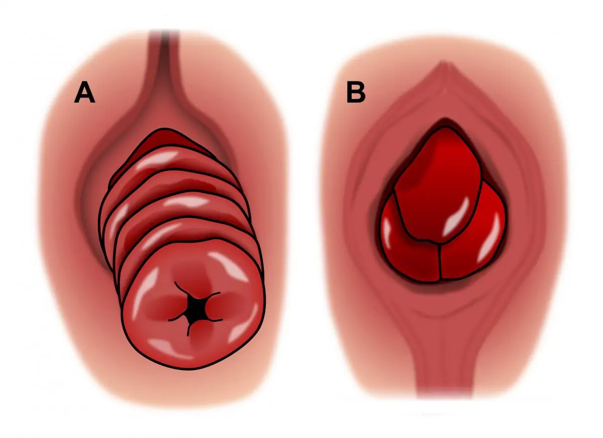 What are the common symptoms of rectal prolapse?