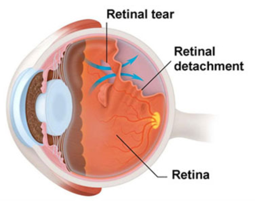 What are the symptoms of diabetic retinopathy?