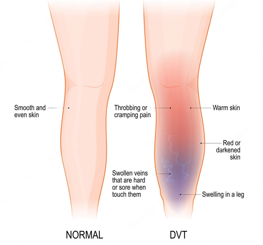 What are the Symptoms of deep vein thrombosis?