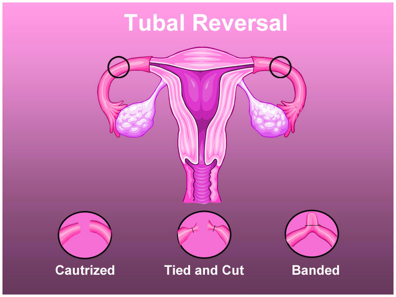 Is tubal ligation reversal always successful, or are there factors that affect its success rate?