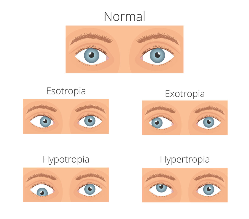 What are the different types of squint eye?