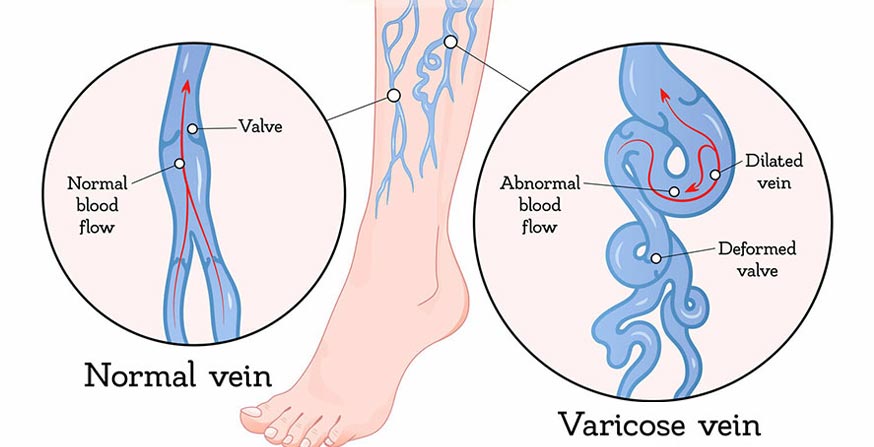 What are the causes of varicose veins?