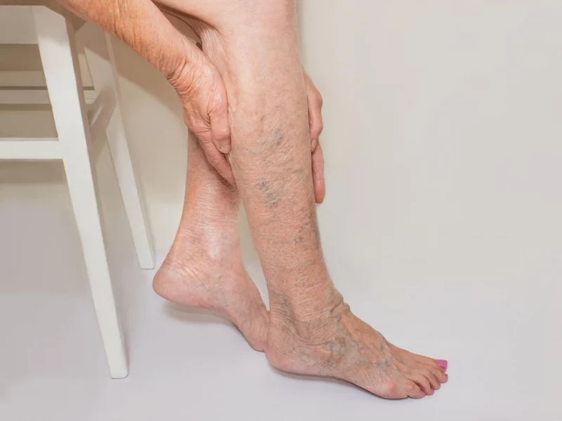 Can varicose veins reoccur after treatment?