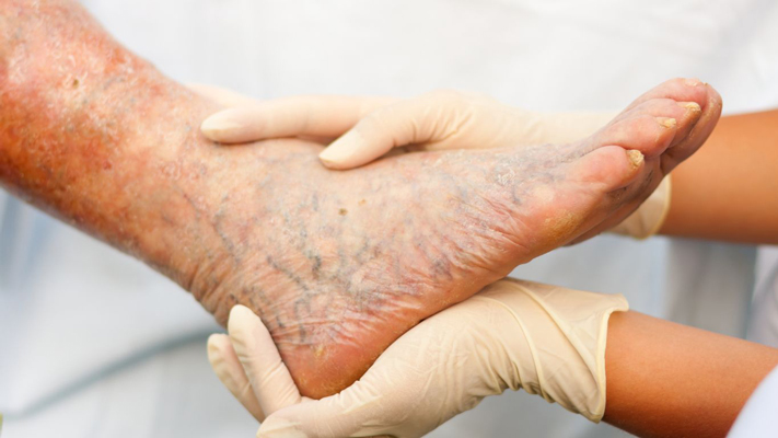 How are varicose veins diagnosed?