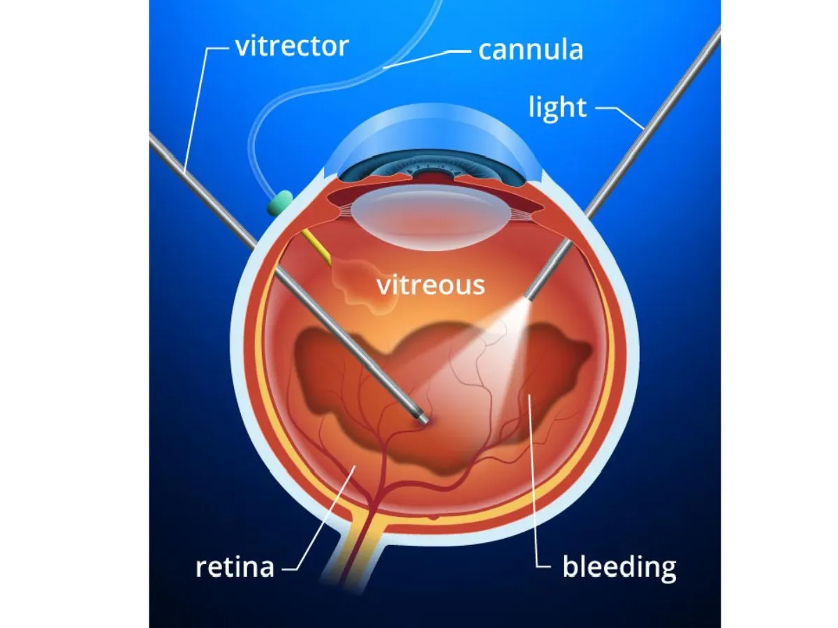 How is vitrectomy different from other eye surgeries, like cataract surgery?