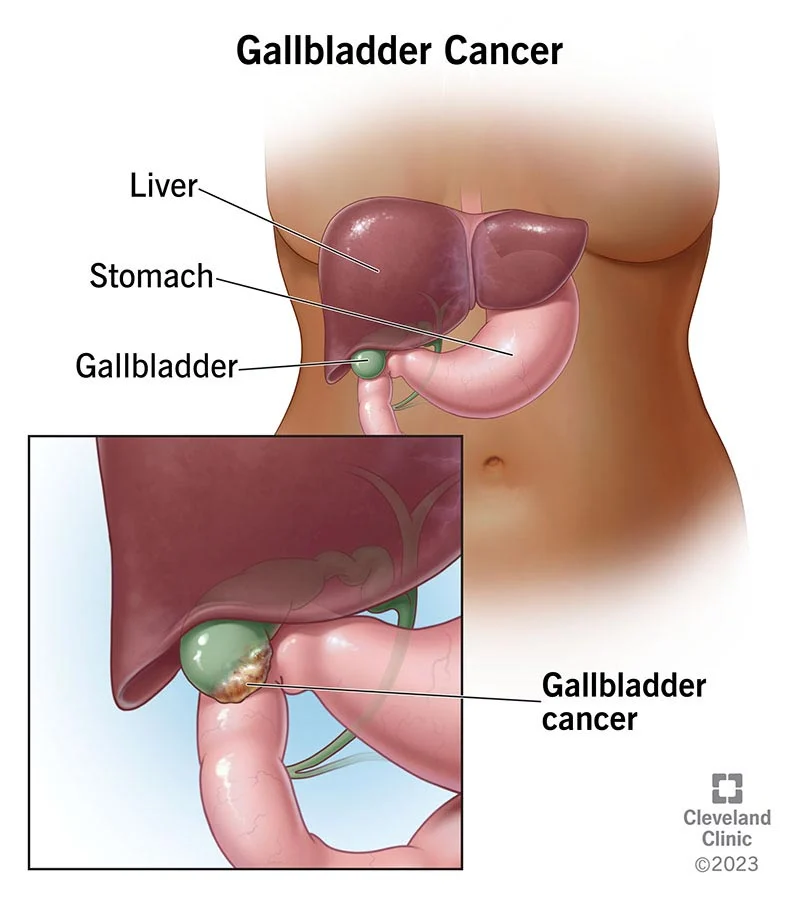 Can Gallstones Cause Gallbladder Cancer?