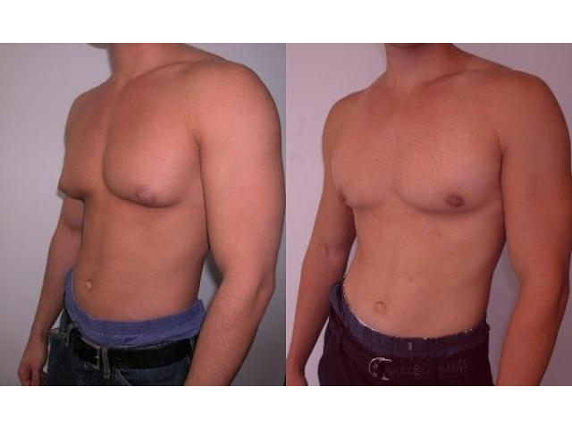 Gynecomastia Surgery in Mumbai