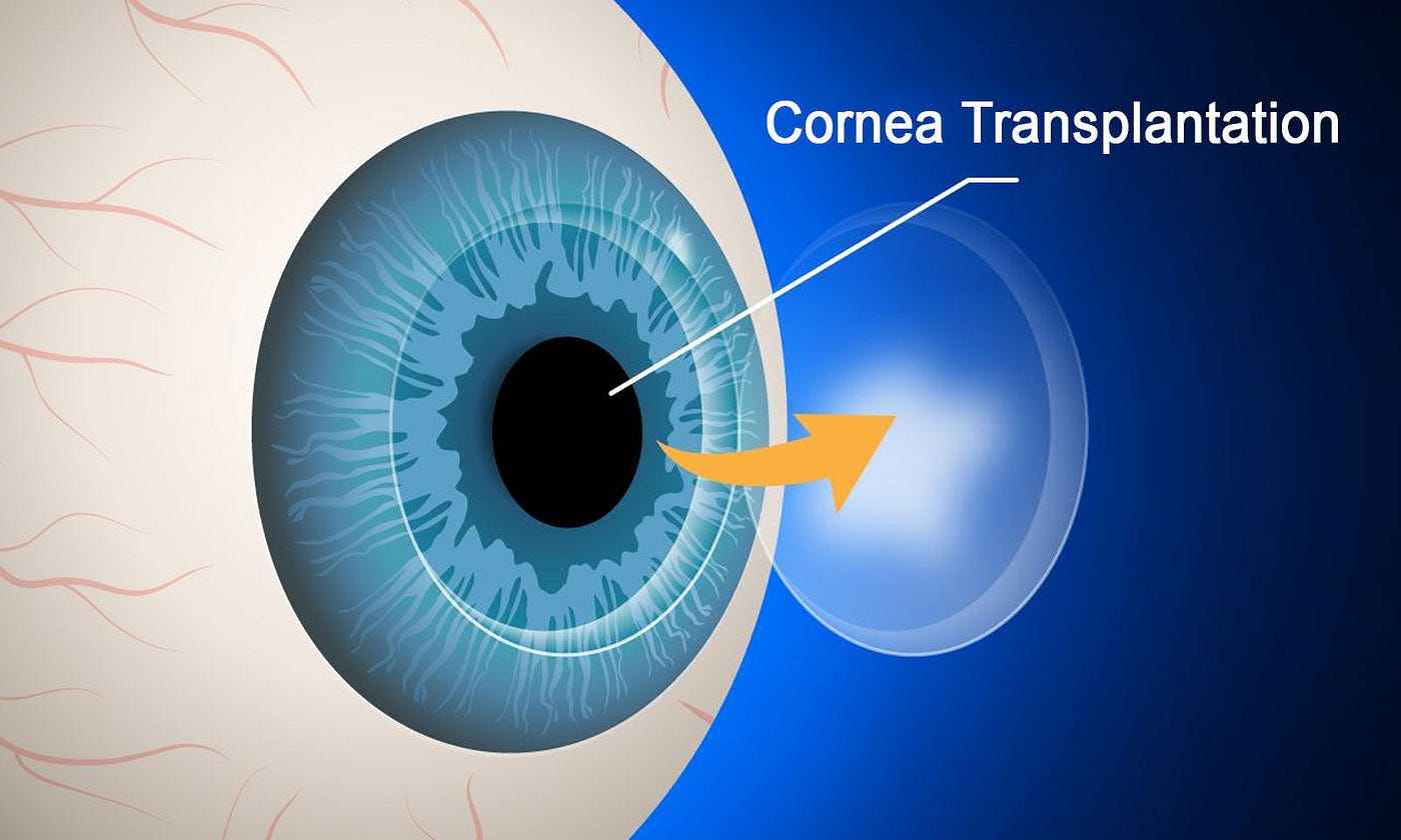 Is corneal transplantation a common procedure?