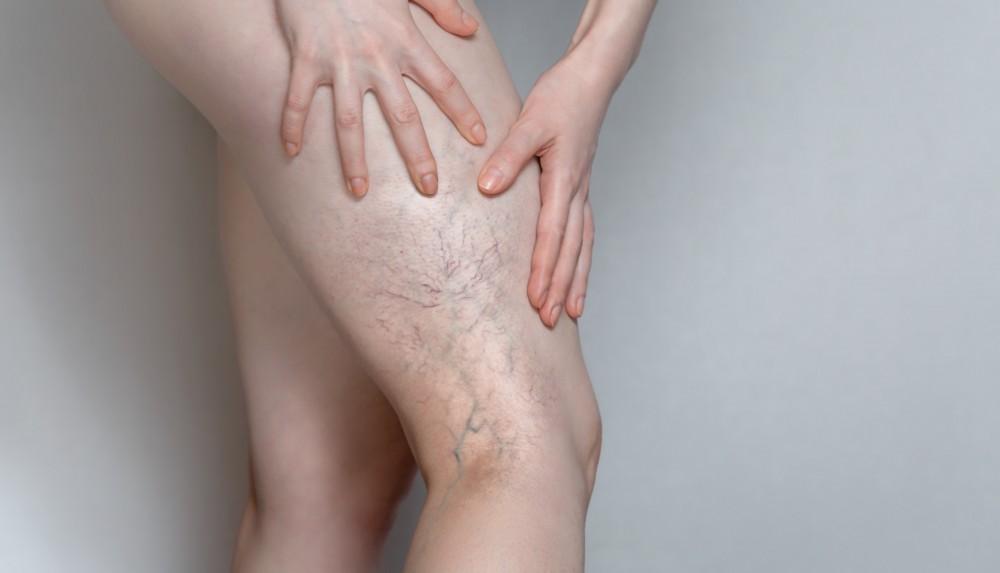 Varicose Vein Treatment in Mumbai