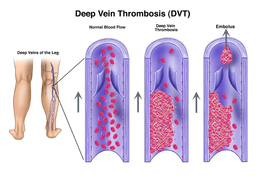 Are there risks associated with interventional DVT treatment?