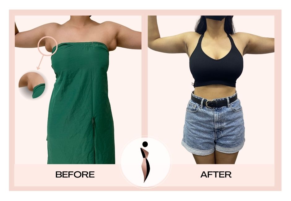 Armpit Fat Removal in Mumbai by Plastic Surgeon | Dr. Amiti Shah