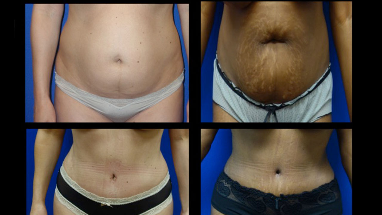 Who is an Ideal Candidate for Tummy Tuck Surgery?