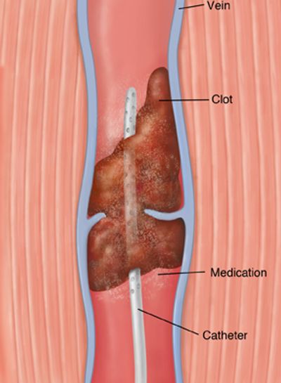 Can Deep Vein Thrombolysis prevent future clots?