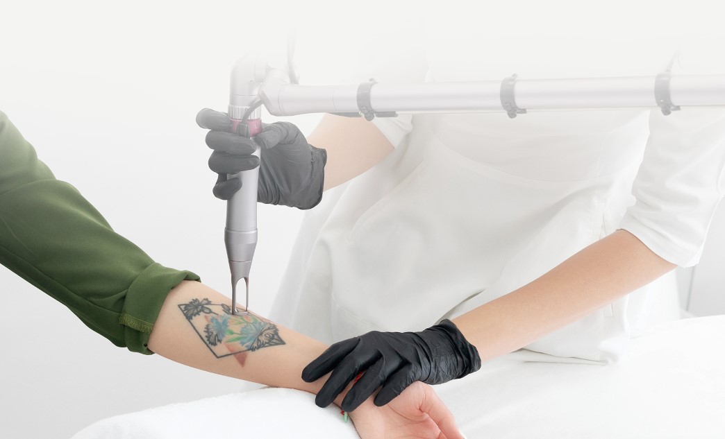 What is Q-Switched Tattoo Removal?