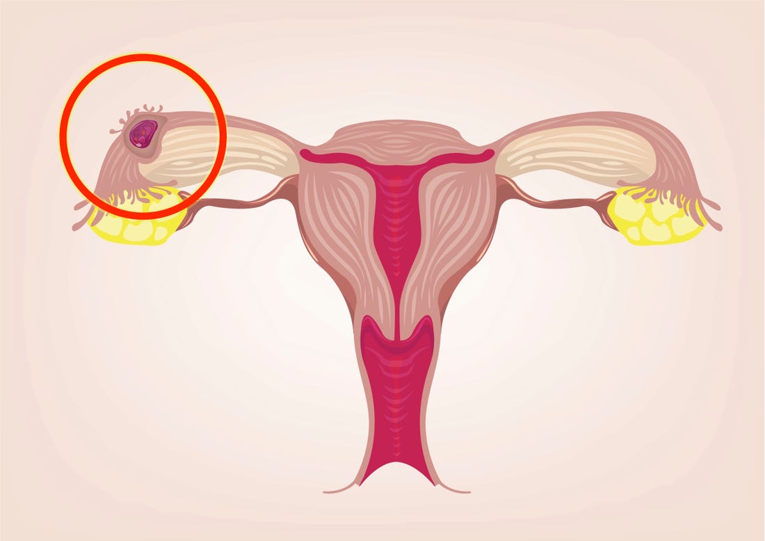 What are the symptoms of an ectopic pregnancy?