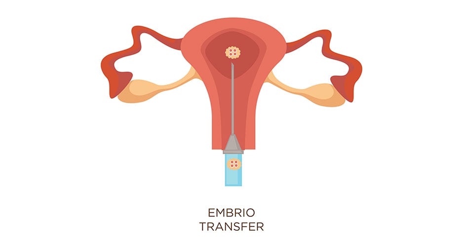 How many embryos should be transferred during IVF?