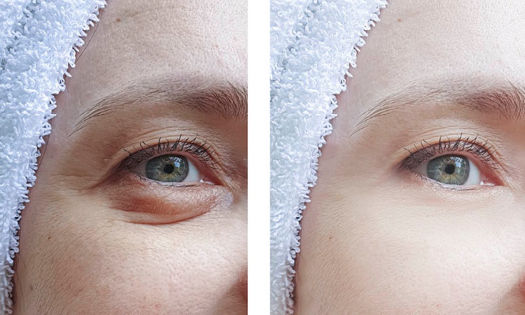 Eyelid Surgery in Mumbai