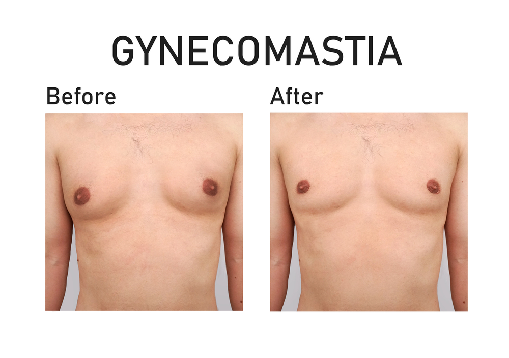 Who is a good candidate for gynecomastia surgery?