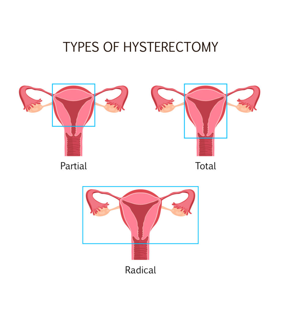 Are there different types of hysterectomy?